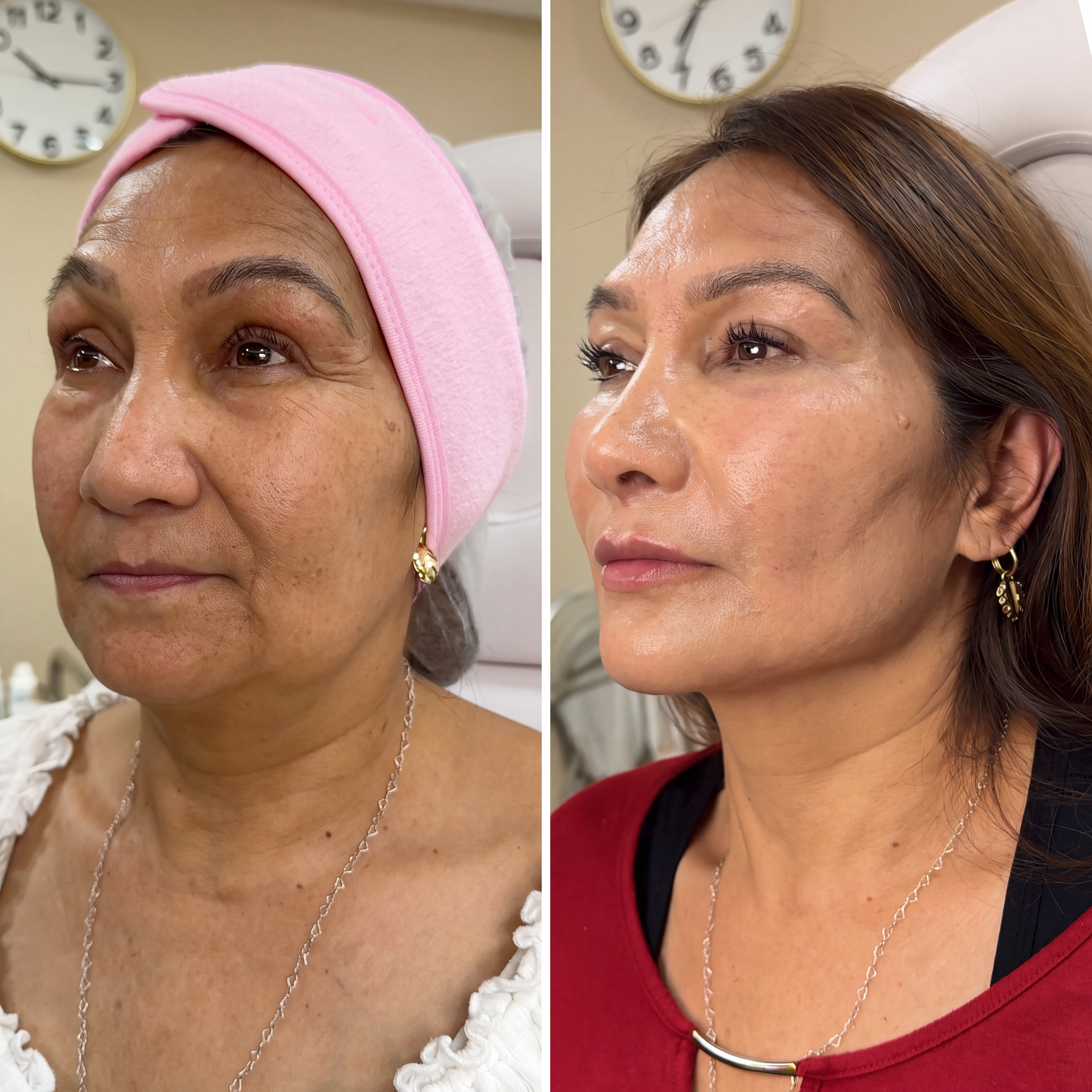 Eumelia, 53 años — contorno mandibular antes y después en Dermodent