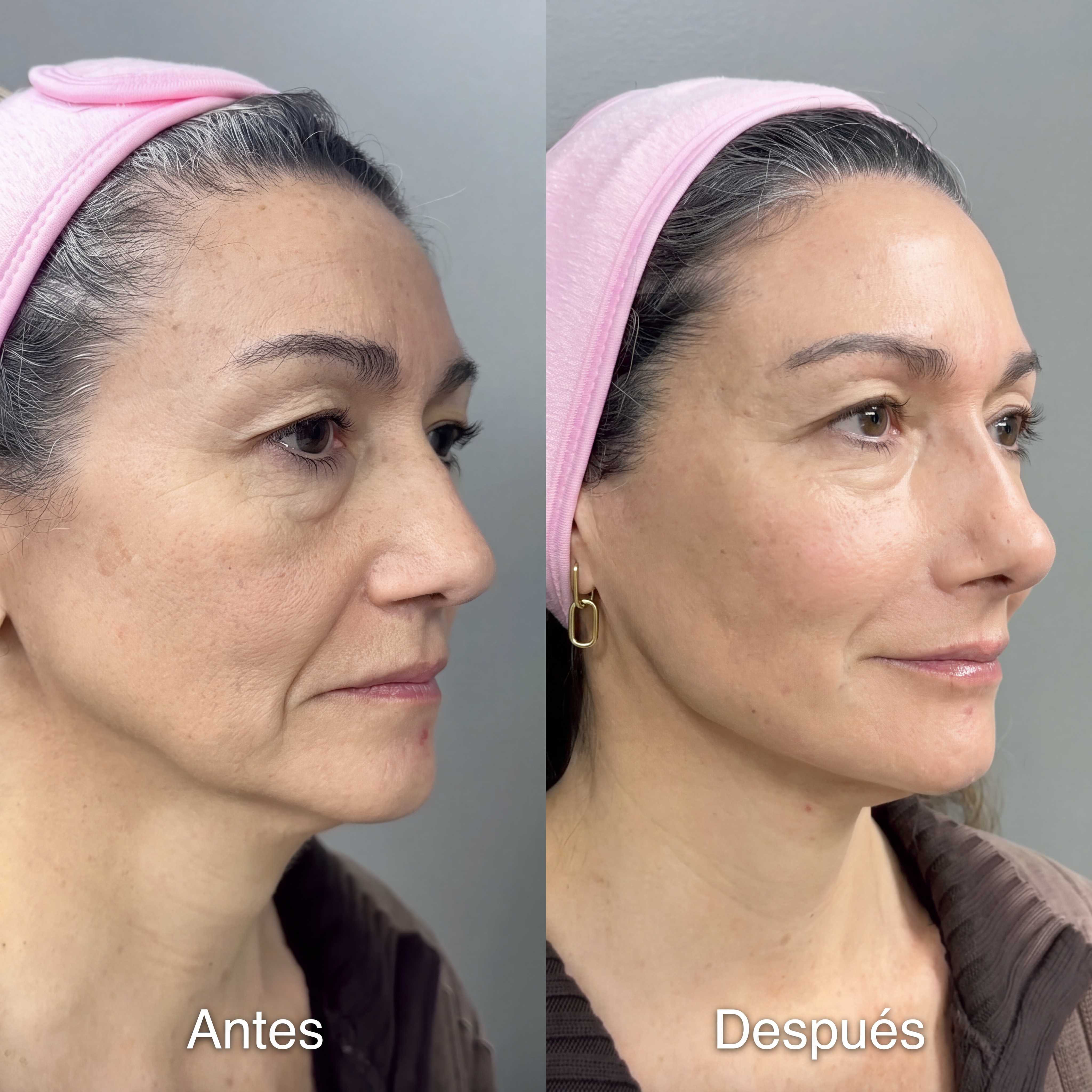 Andrea — contorno mandibular antes y después en Dermodent