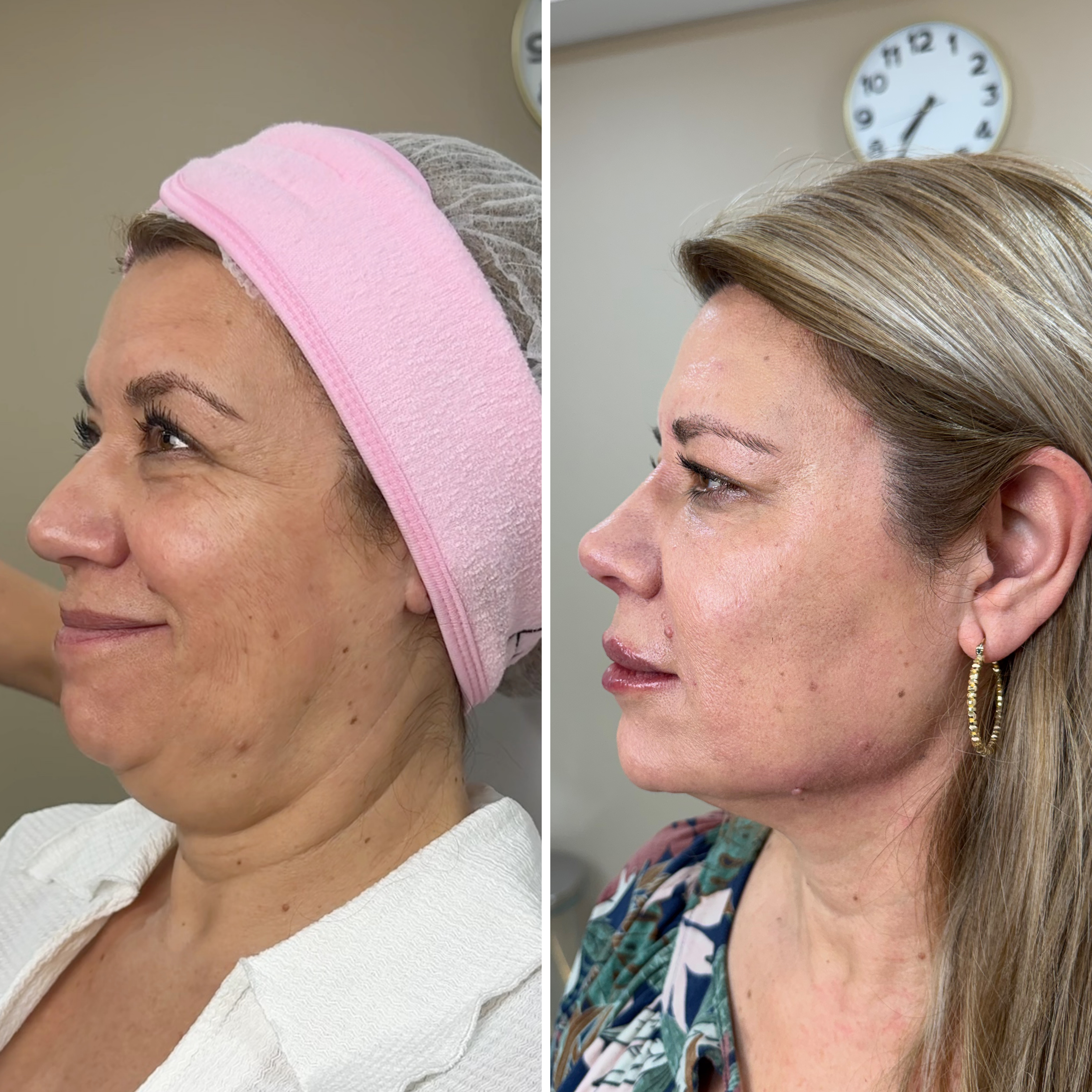 Paola — tratamiento del contorno con endolaser y ácido hialurónico en Dermodent