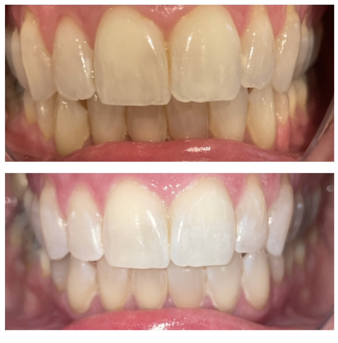 Republic Smiles teeth whitening result 4
