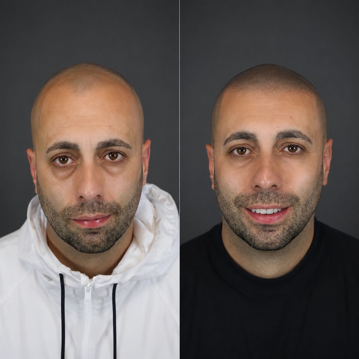 Antes y después de micropigmentación capilar, caso 1