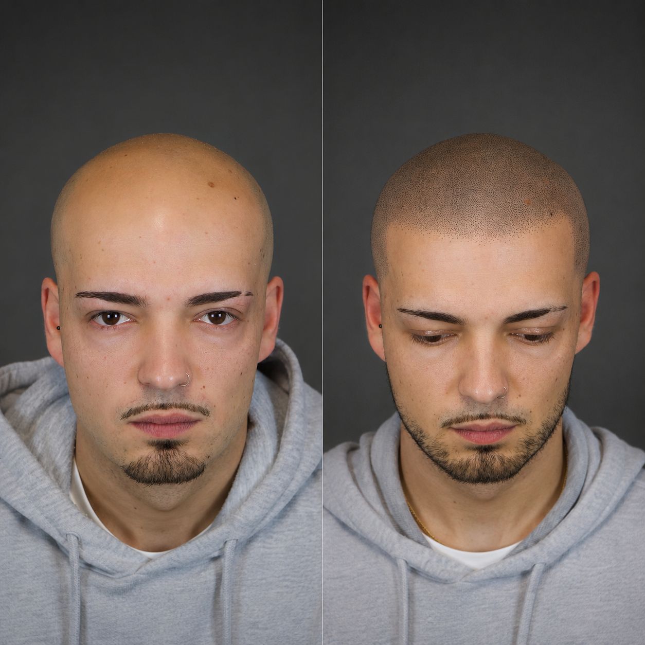 Antes y después de un tratamiento de micropigmentación capilar