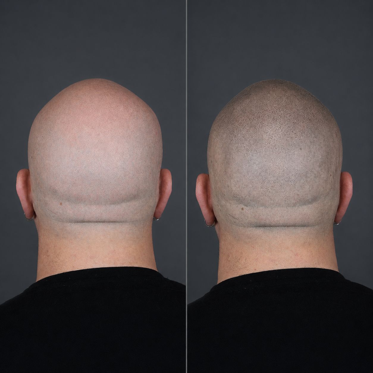 Antes y después de micropigmentación capilar, caso 6