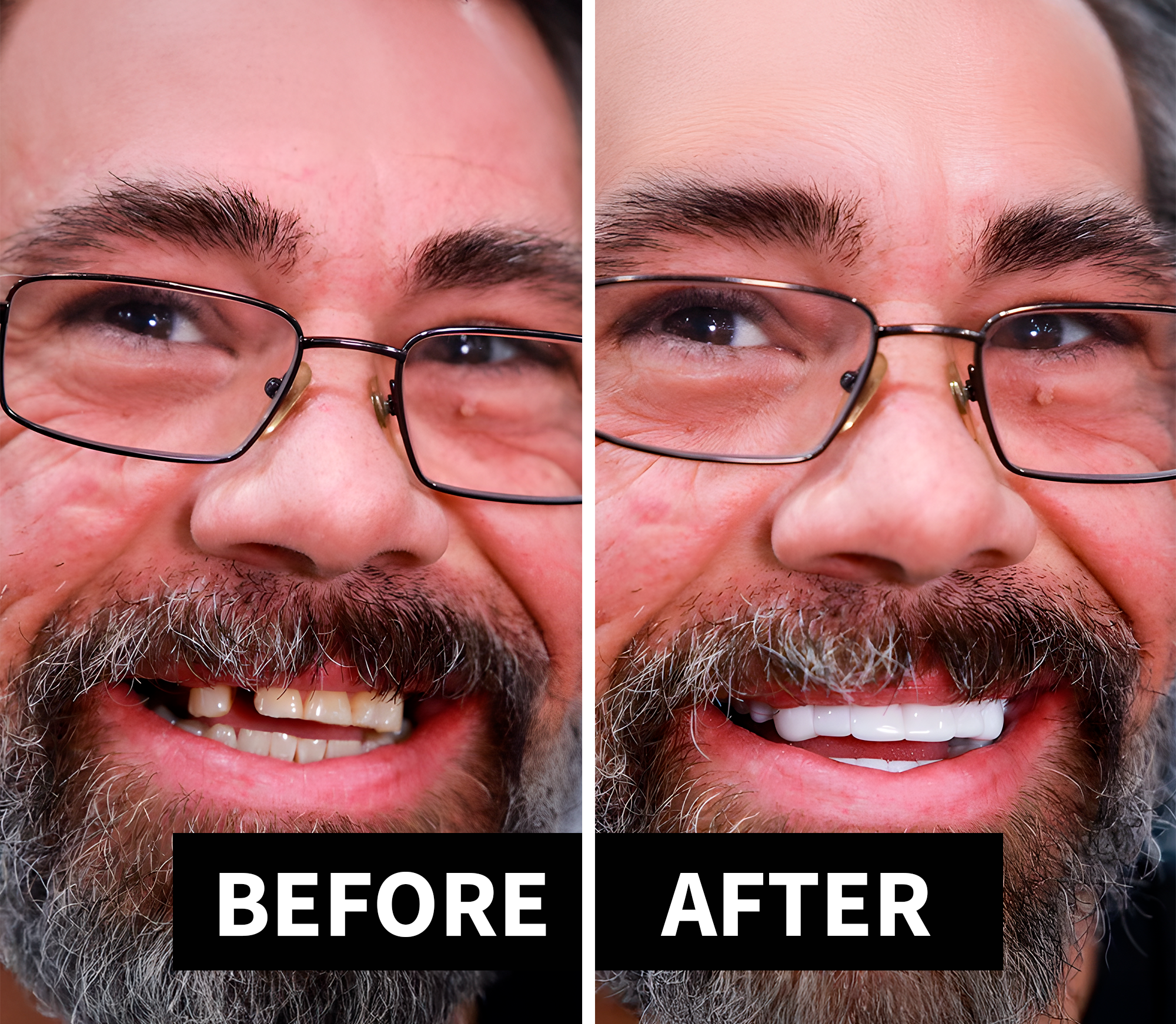 Shiny Smile Veneers