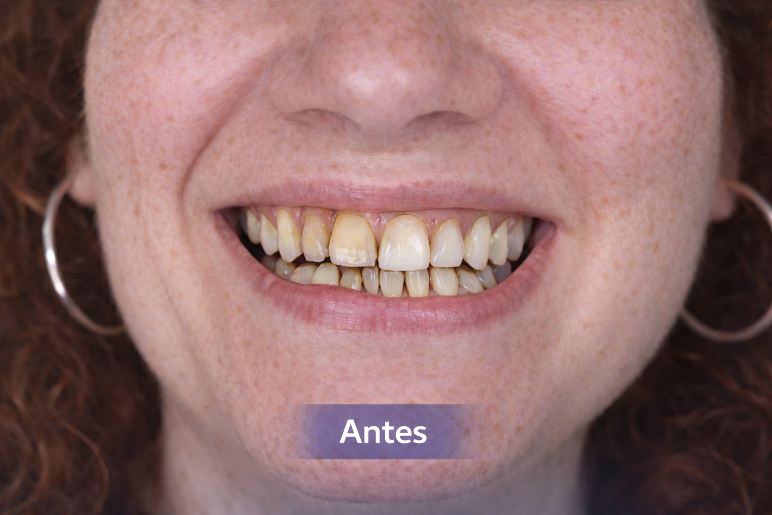 Antes diseño de sonrisa