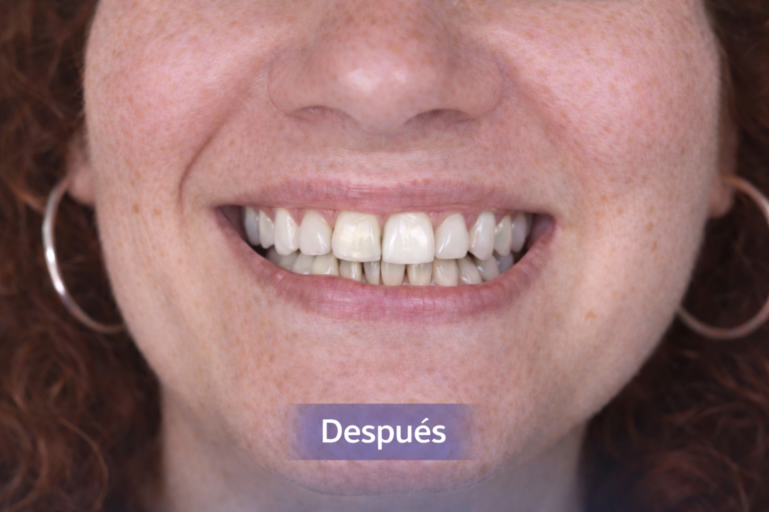 Después diseño de sonrisa