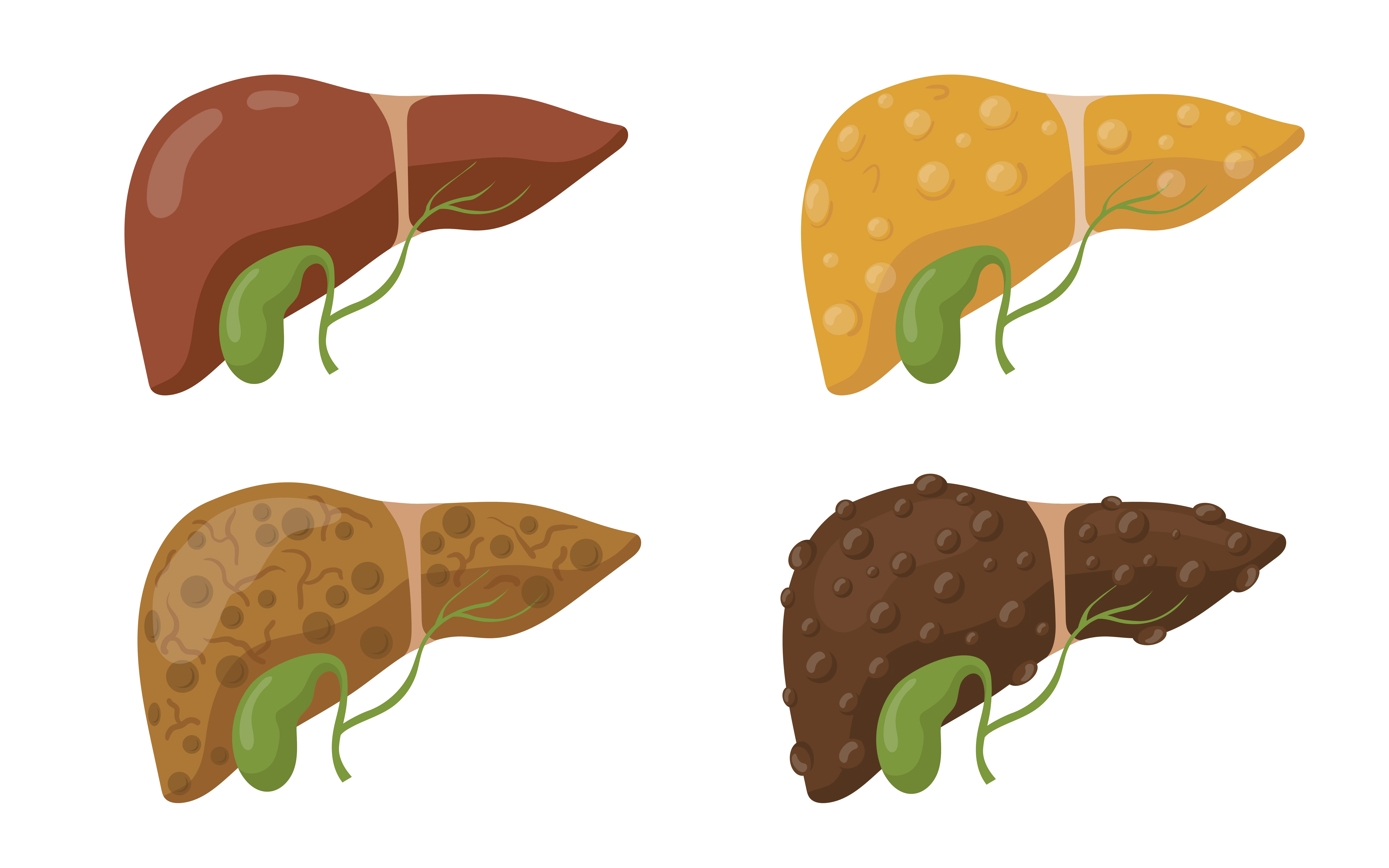 Ilustración de cuatro etapas de la enfermedad hepática, desde hígado sano hasta hígado graso, fibrosis y cirrosis.