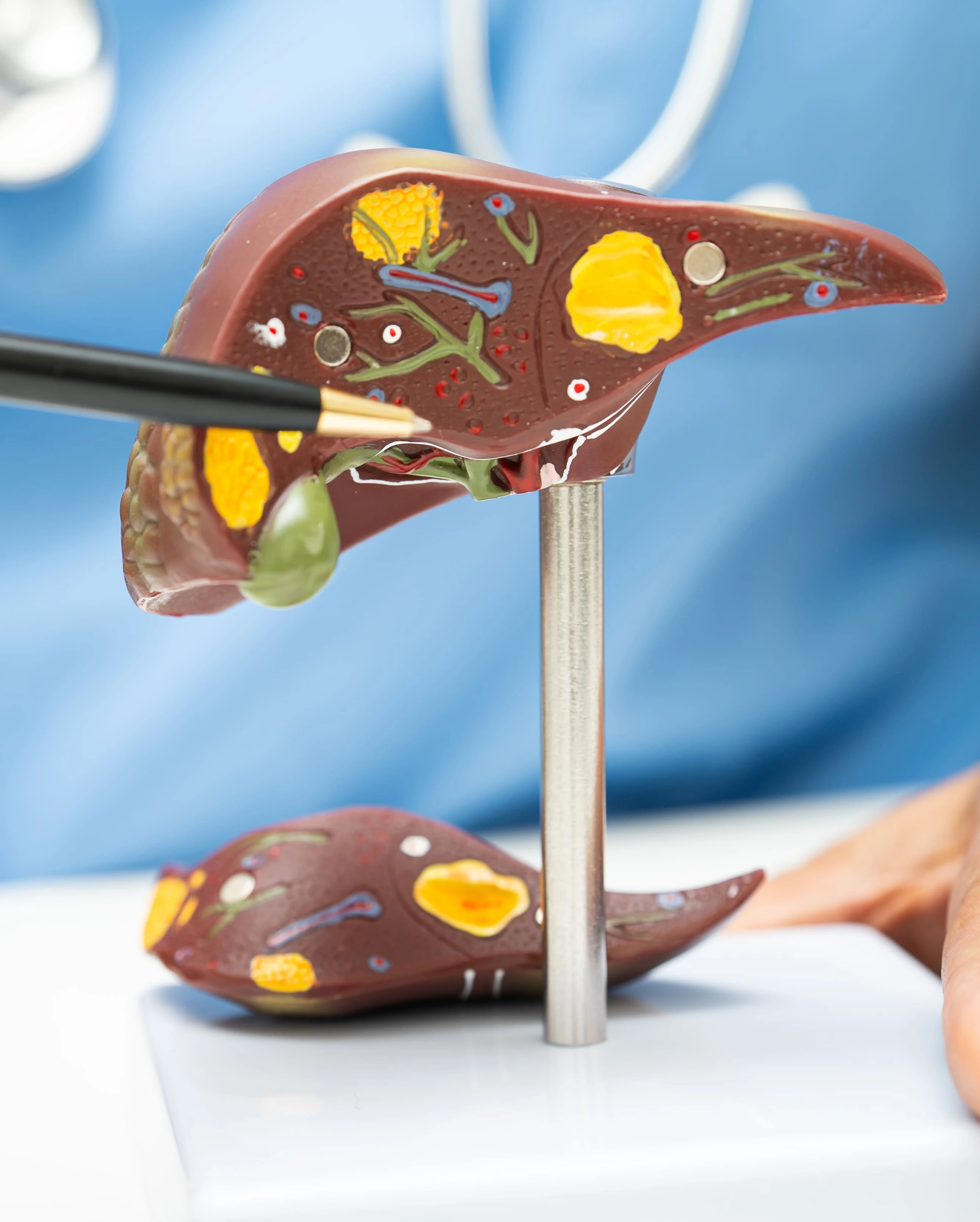 Médico con bata blanca mostrando un modelo anatómico de higado graso mientras lo señala con un bolígrafo.