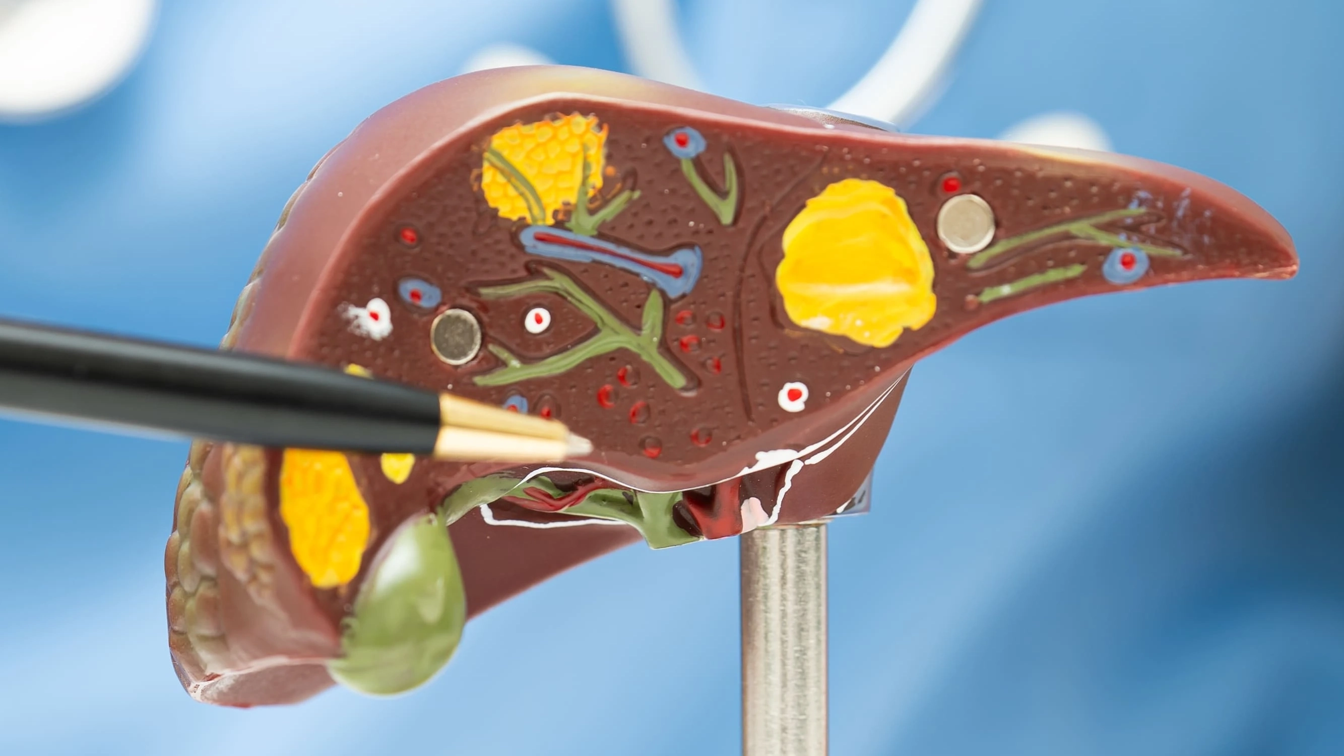 Médico mostrando un modelo anatómico de higado graso mientras lo señala con un bolígrafo.