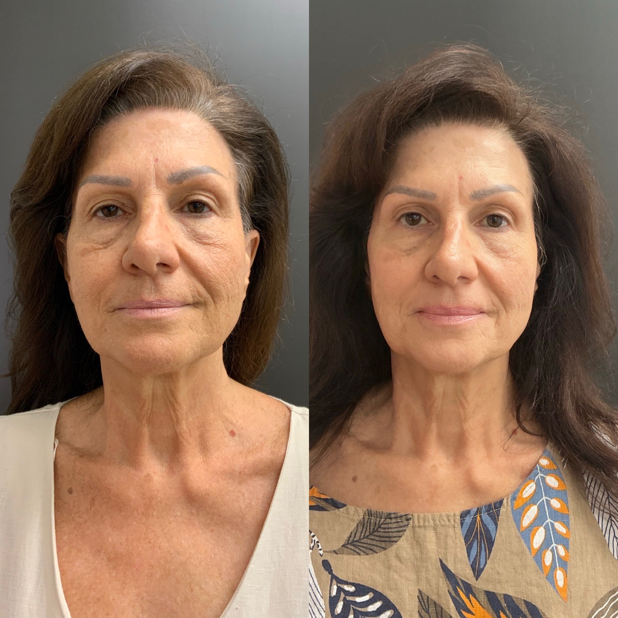 Before and after facial balancing at Chin Up Aesthetics — patient 1