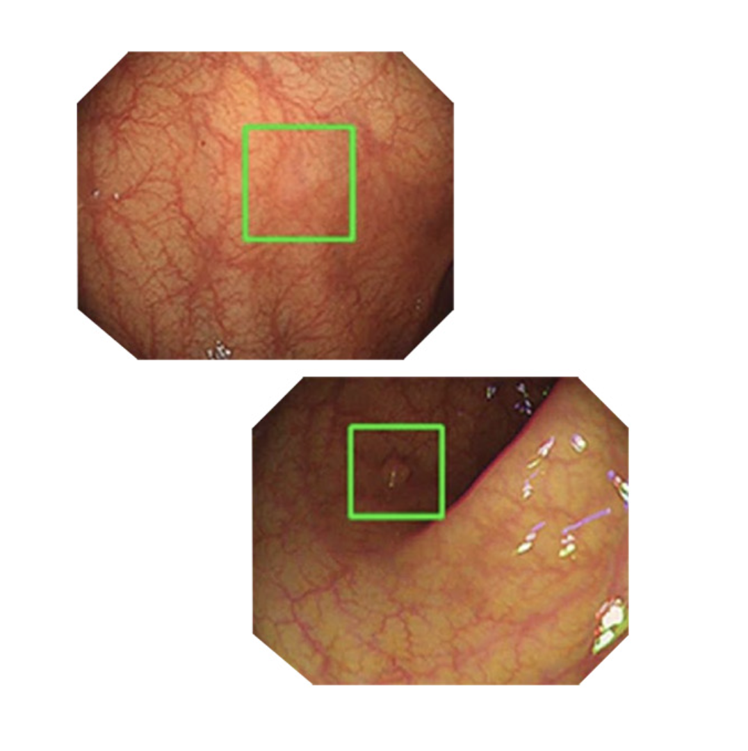 AI輔助大腸鏡檢查