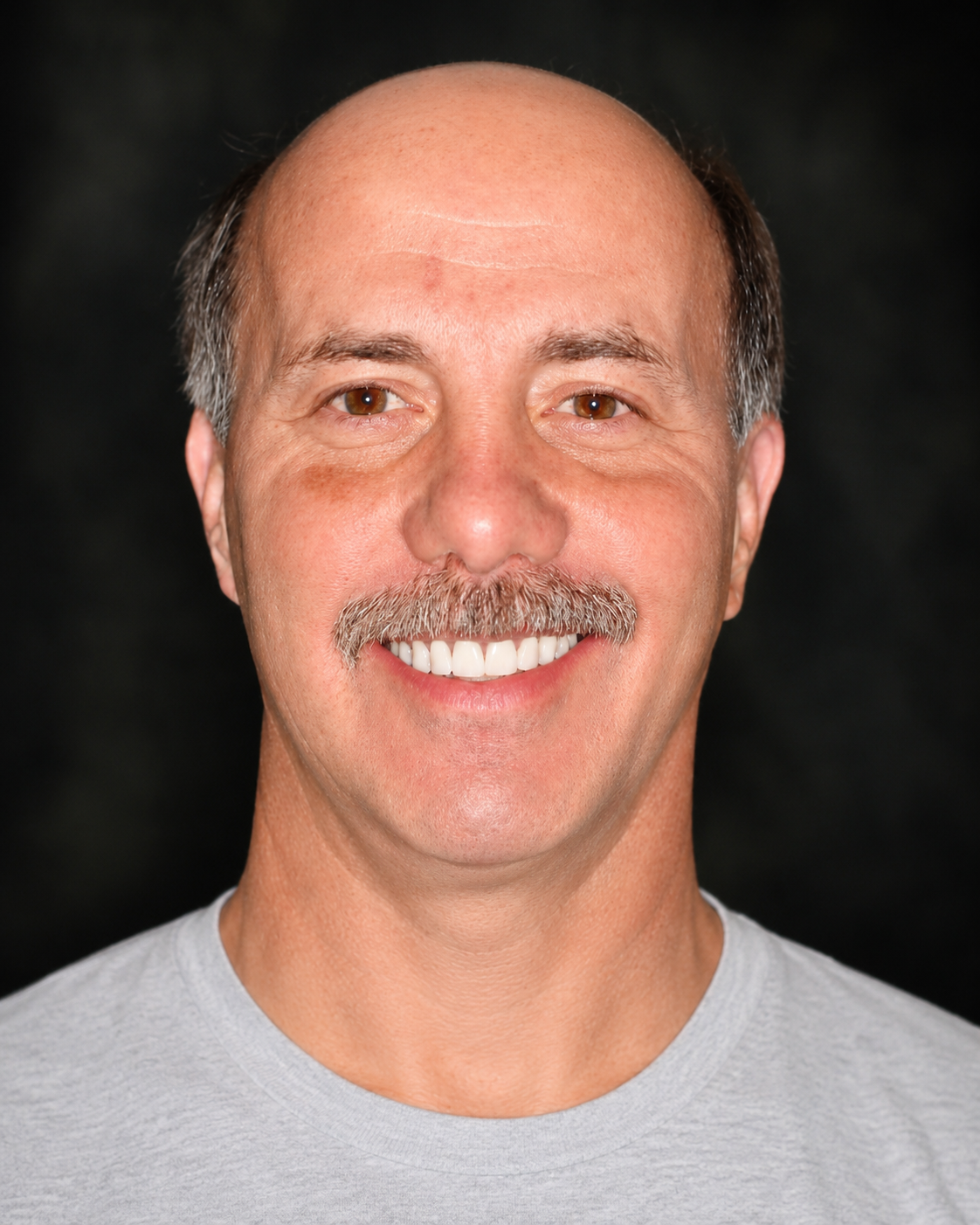 After professional teeth whitening