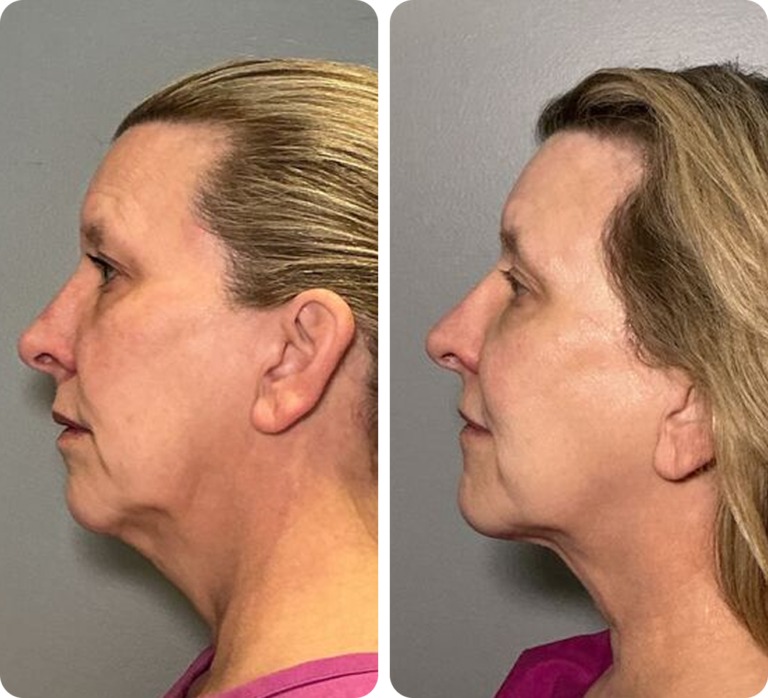 T-Shape 2 before and after