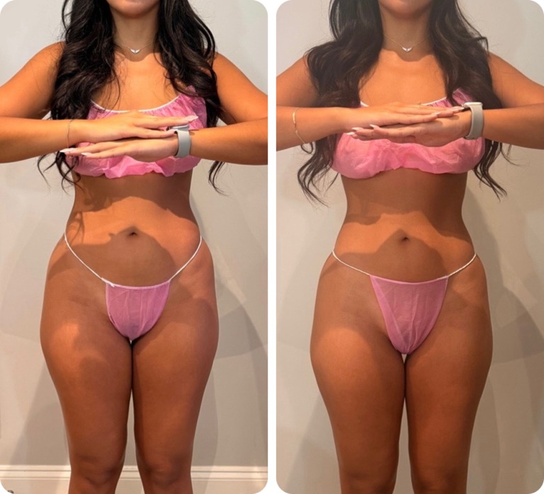 T-Shape 2 before and after