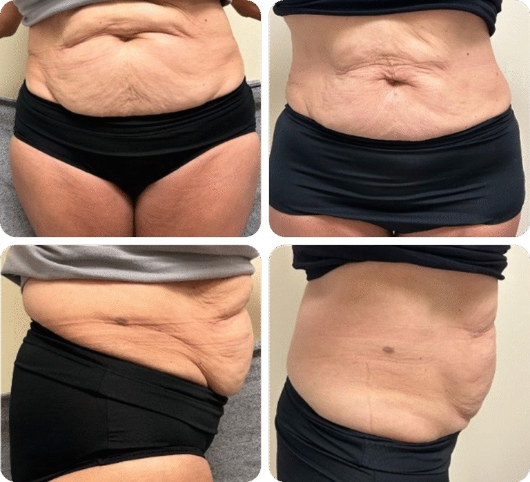 T-Shape 2 before and after