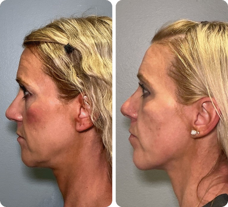 T-Shape 2 before and after