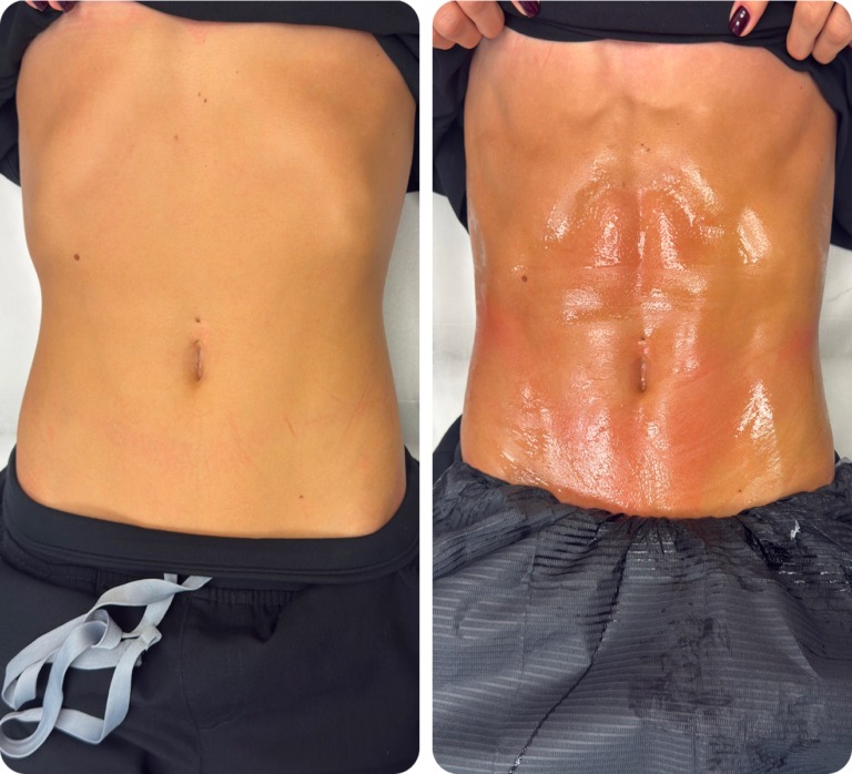 T-Shape 2 before and after