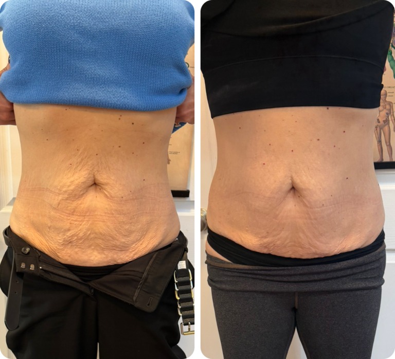 T-Shape 2 before and after