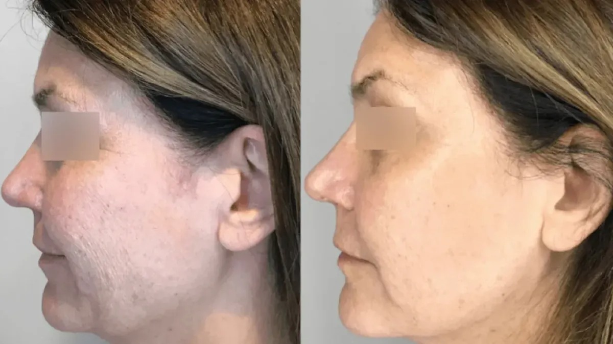 T-Shape 2 before and after