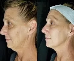 T-Shape 2 before and after