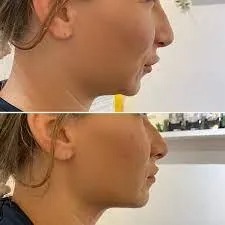 T-Shape 2 before and after