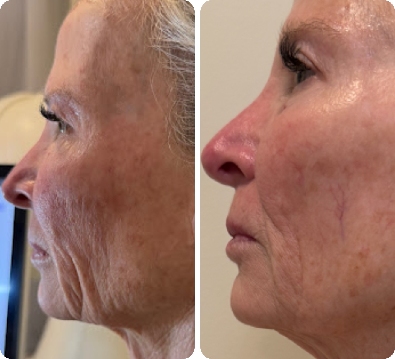 T-Shape 2 before and after