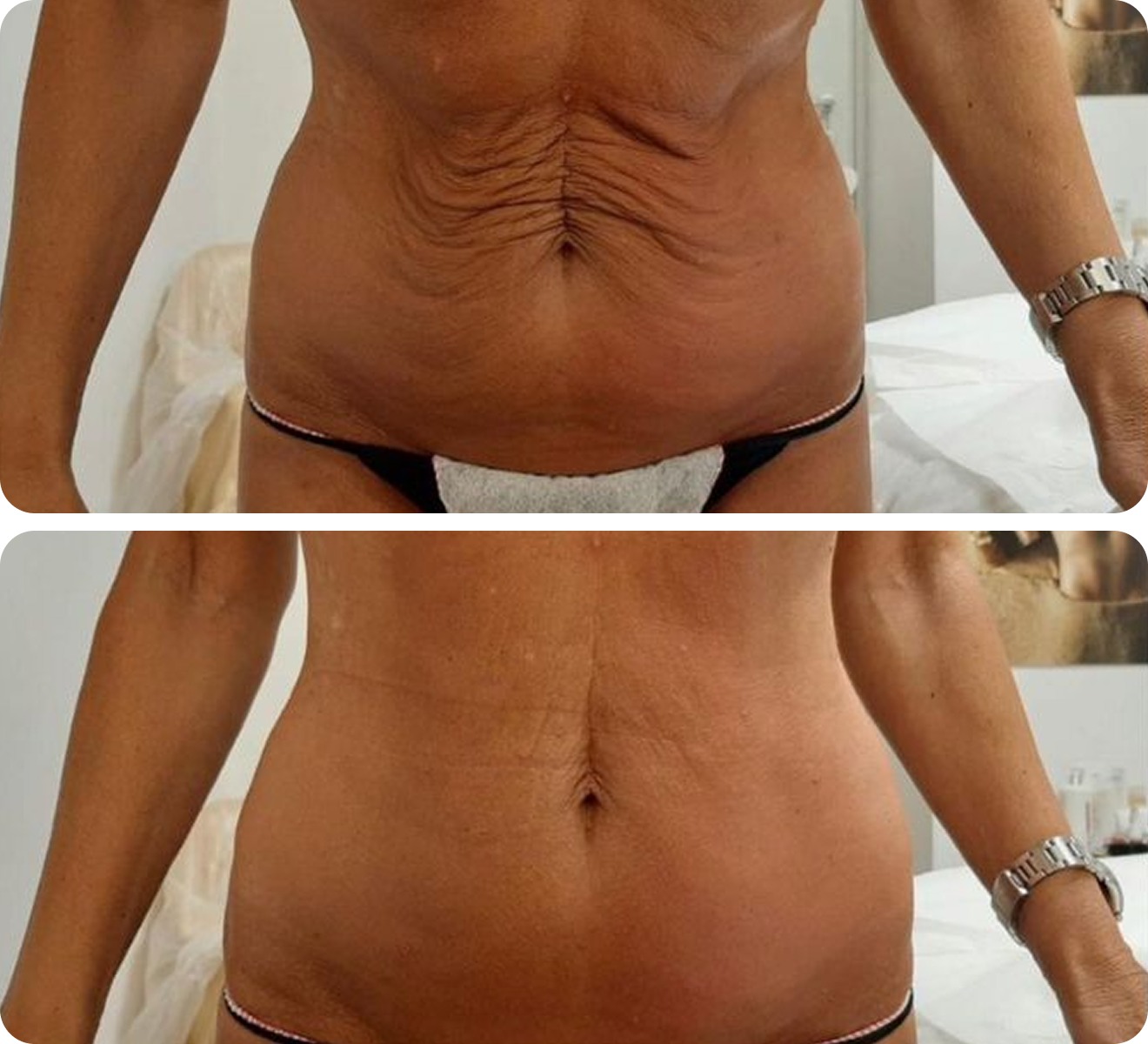 T-Shape 2 before and after