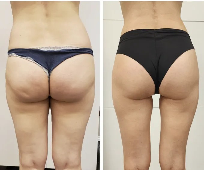 T-Shape 2 before and after