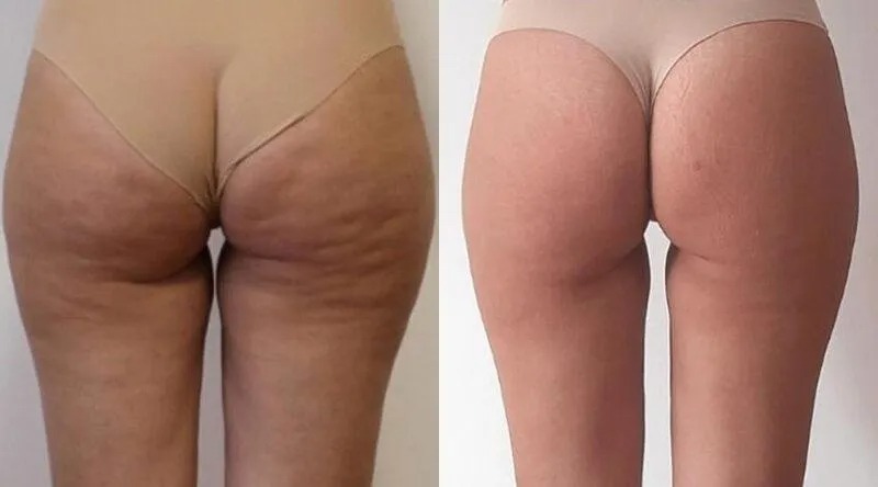 T-Shape 2 before and after