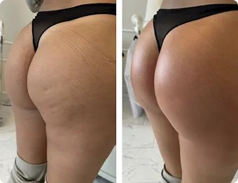 T-Shape 2 before and after