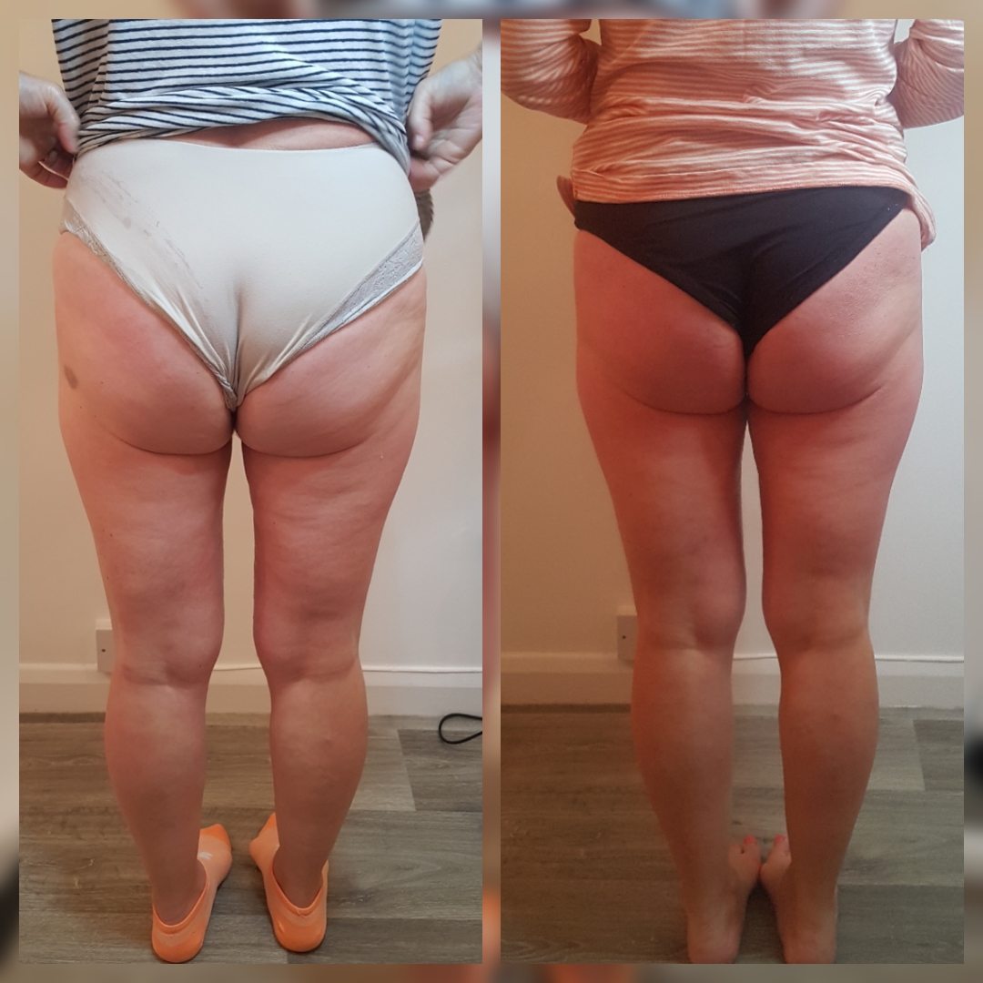 Glutes T-Shape 2 before and after