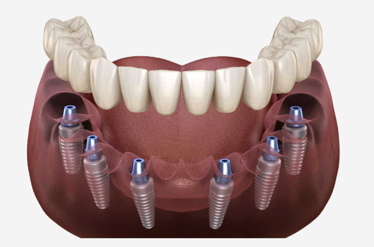 all on x dental implants
