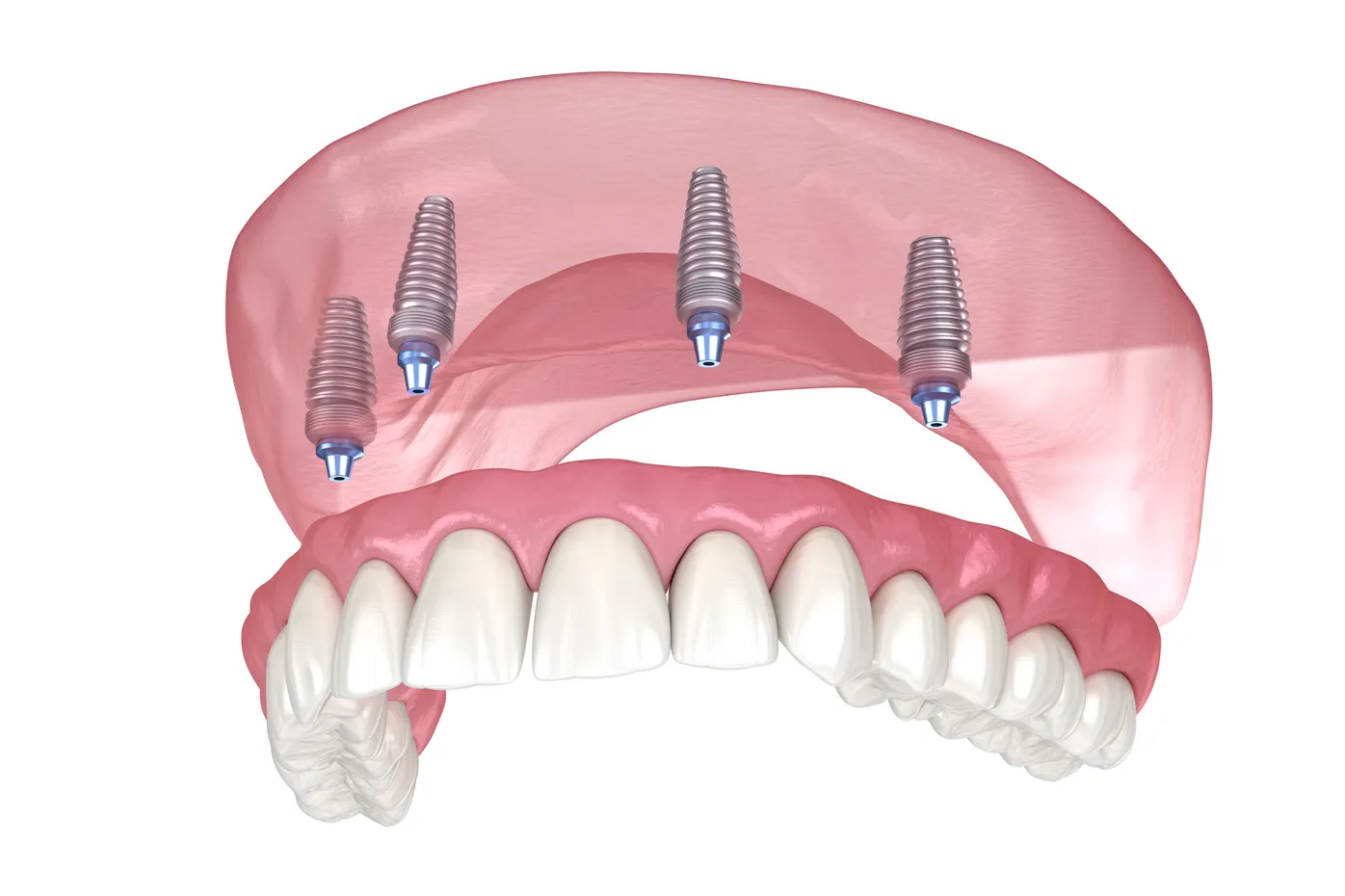 Full-arch All-on-4 implants