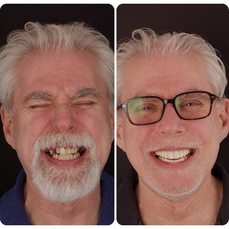 Before and after All-on-X patient transformation