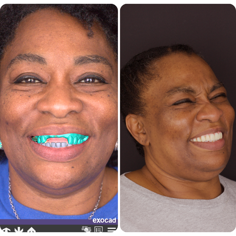 Before and after dental implant patient