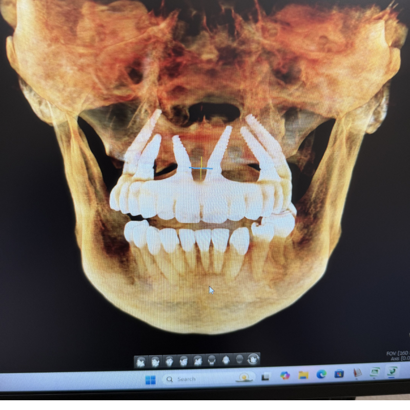 Zygomatic implants