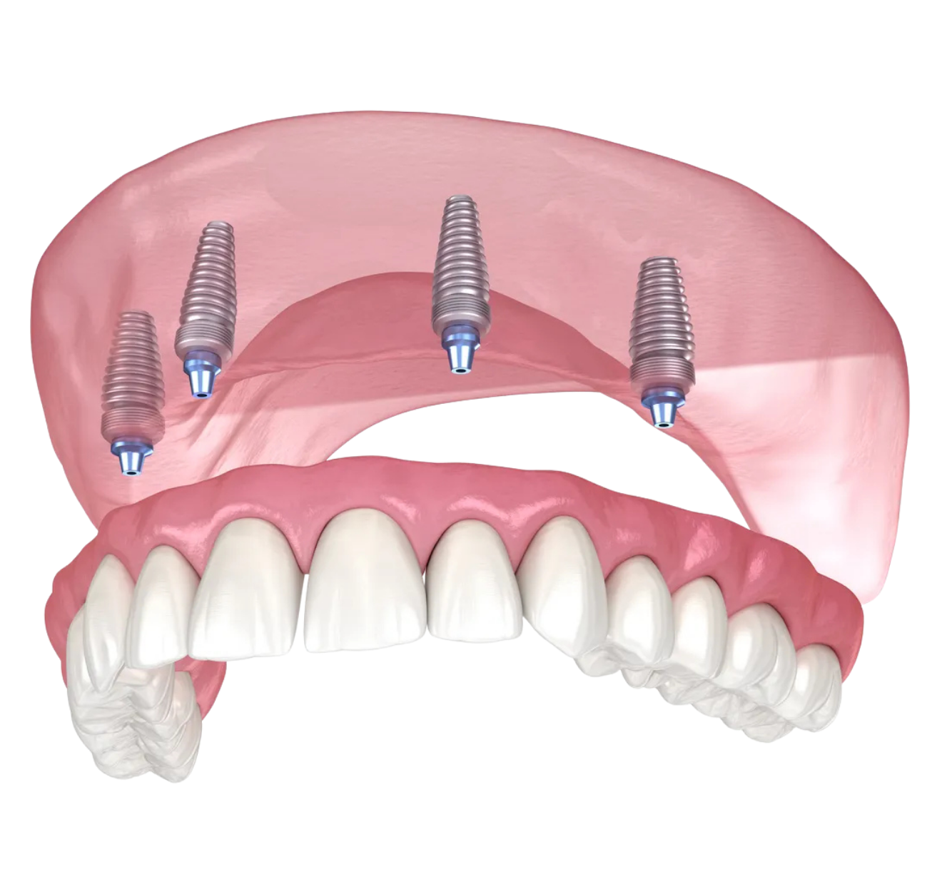 All-on-X dental implant product detail
