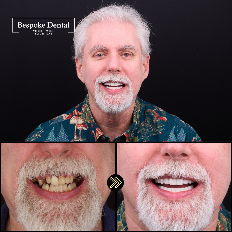 A Bespoke Dental patient in Lutz, Florida, after implant treatment
