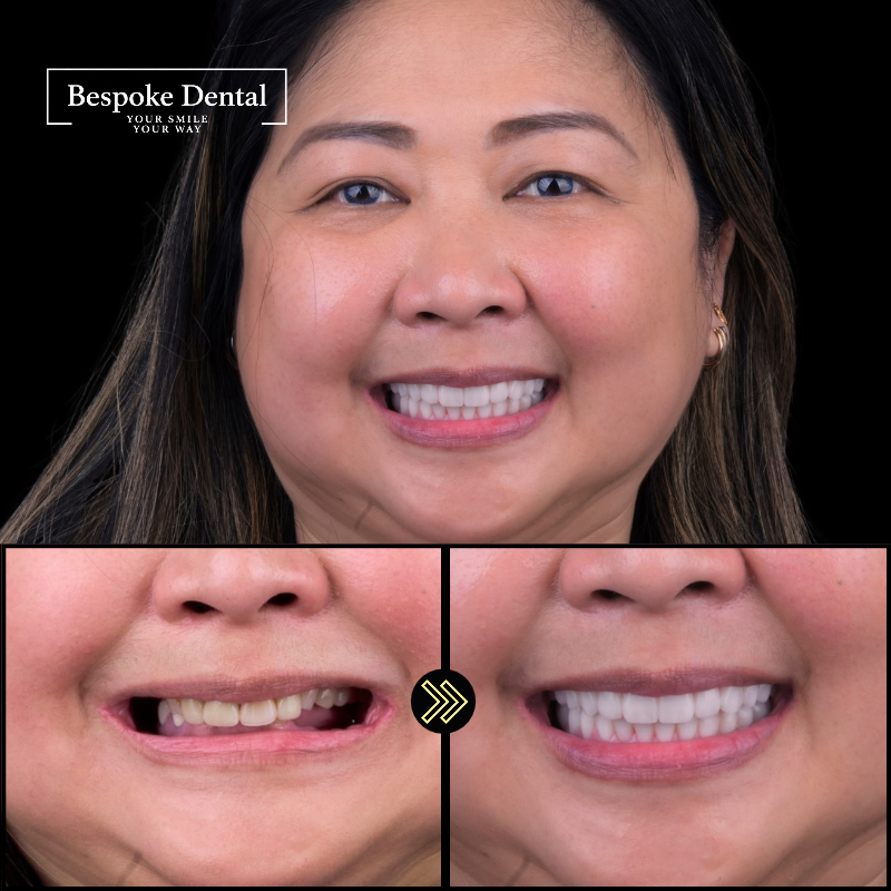 Bespoke Dental patient result 2