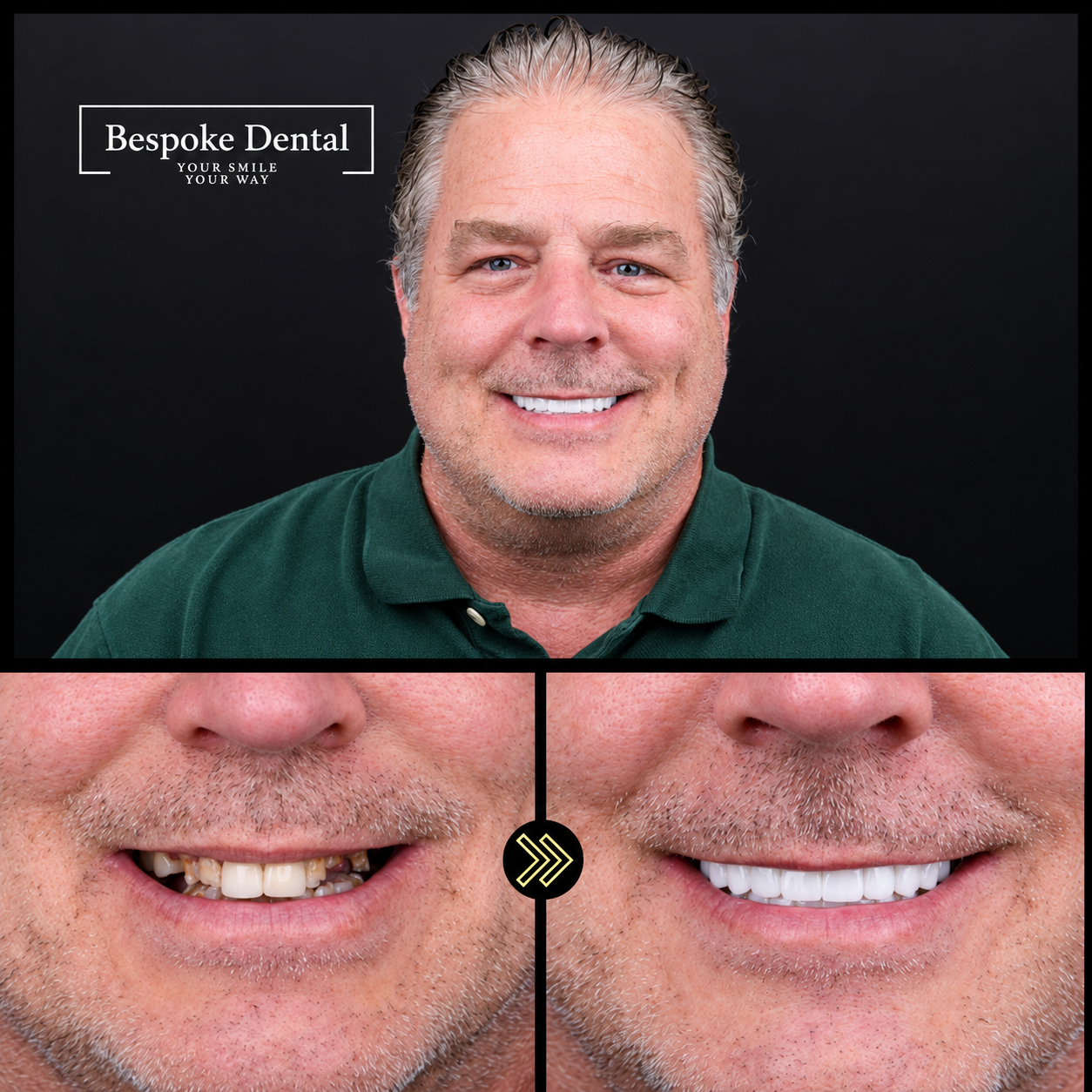 Bespoke Dental patient result 4