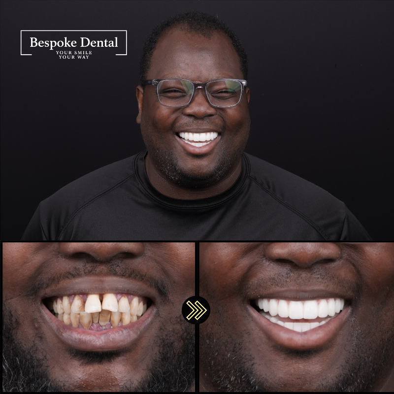 Bespoke Dental patient result 5
