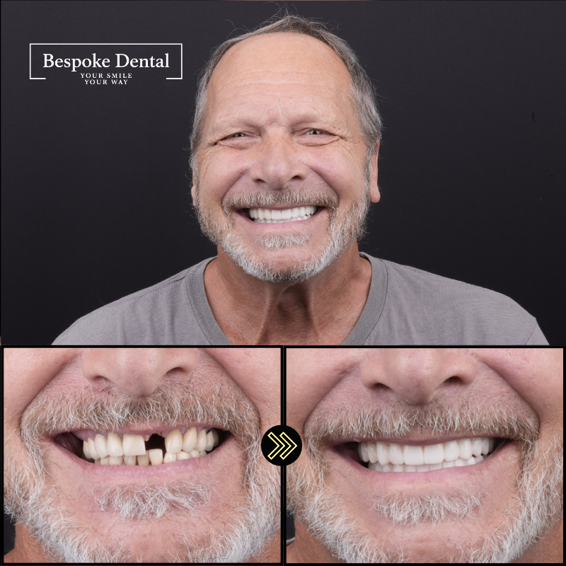 Bespoke Dental patient result 3