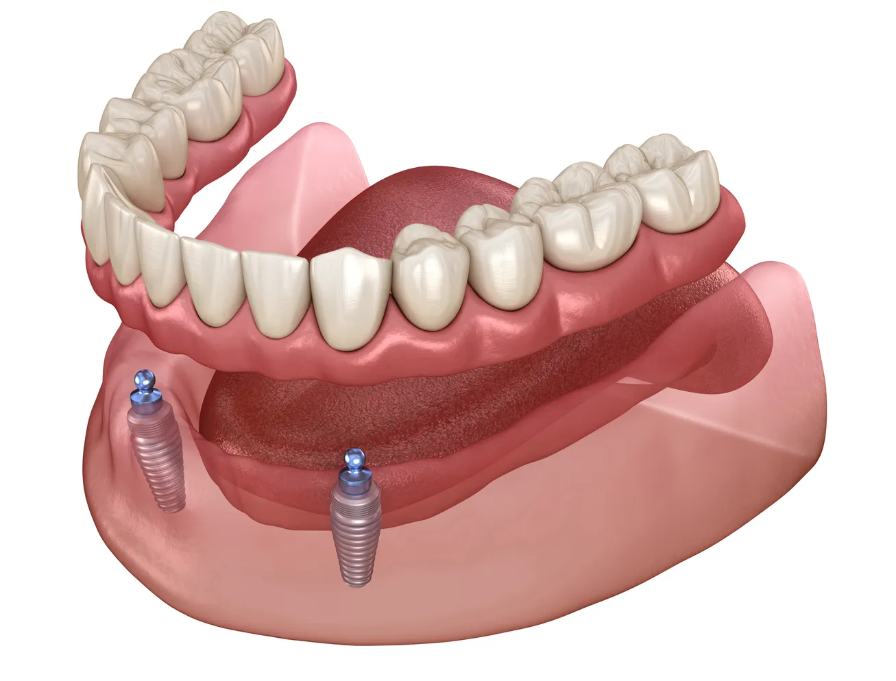 snap on dentures implants