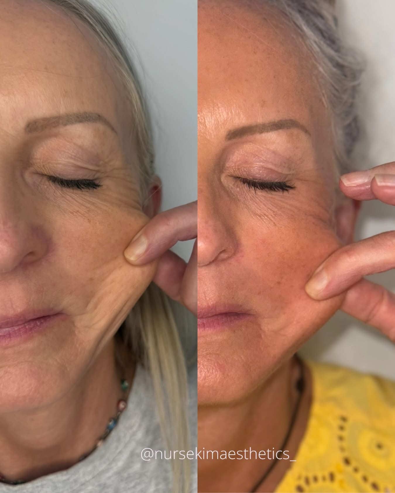 Sculptra result