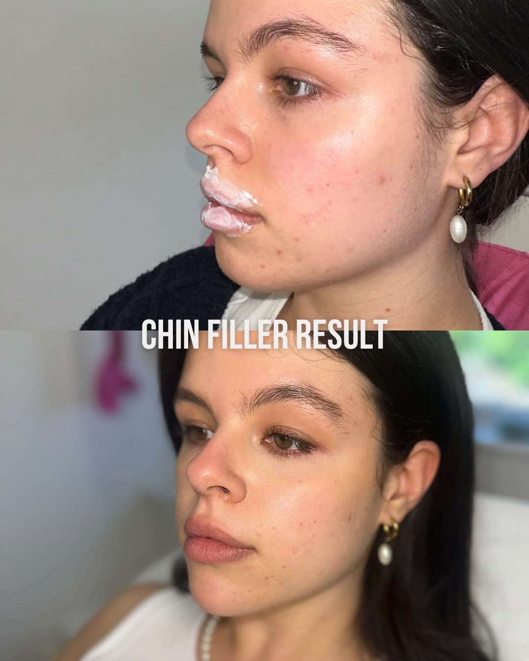 Chin Filler result
