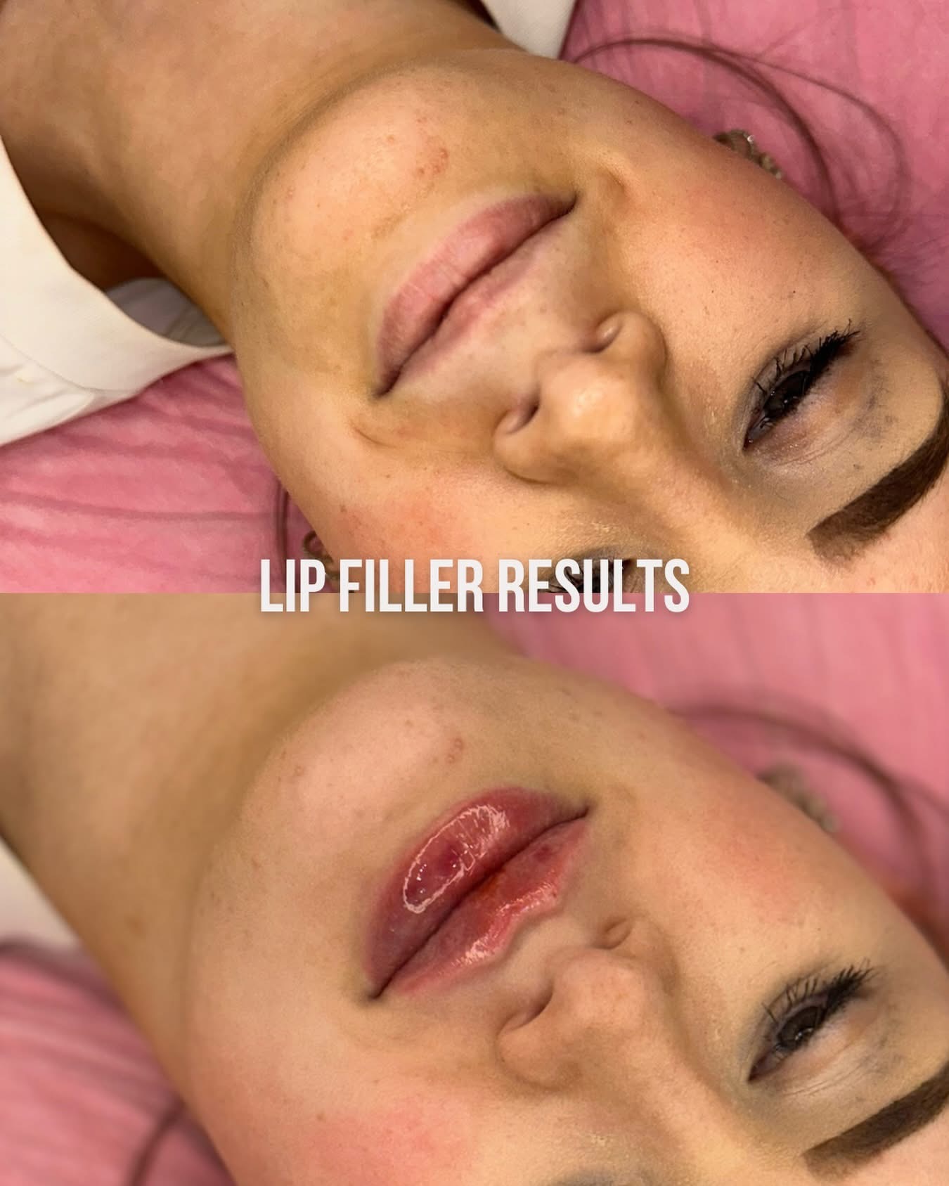 Lip Filler result