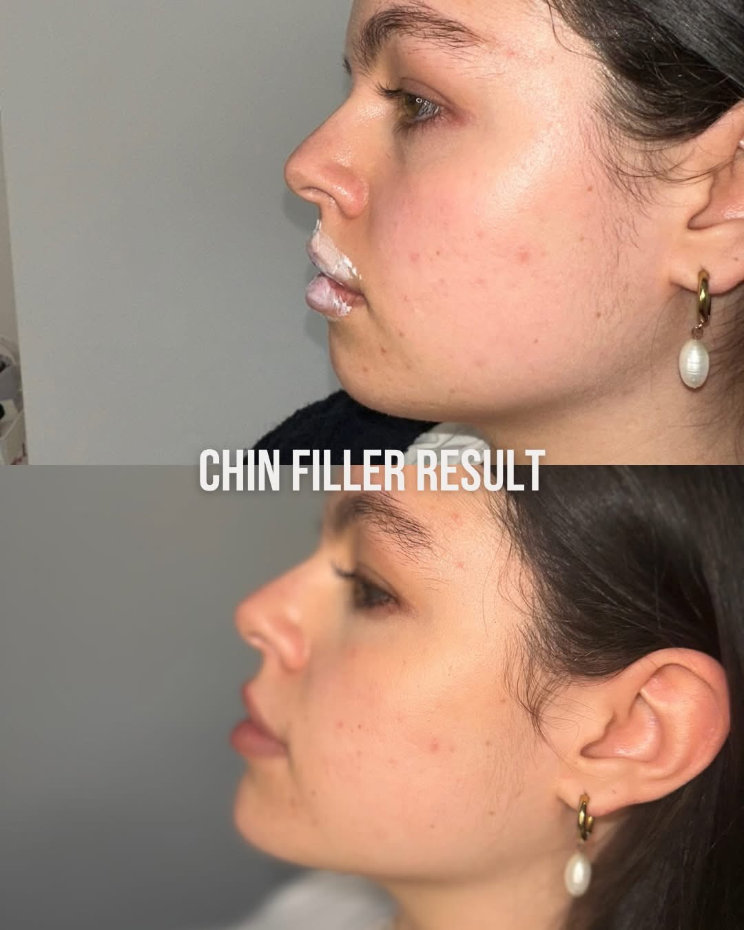 Chin Filler result