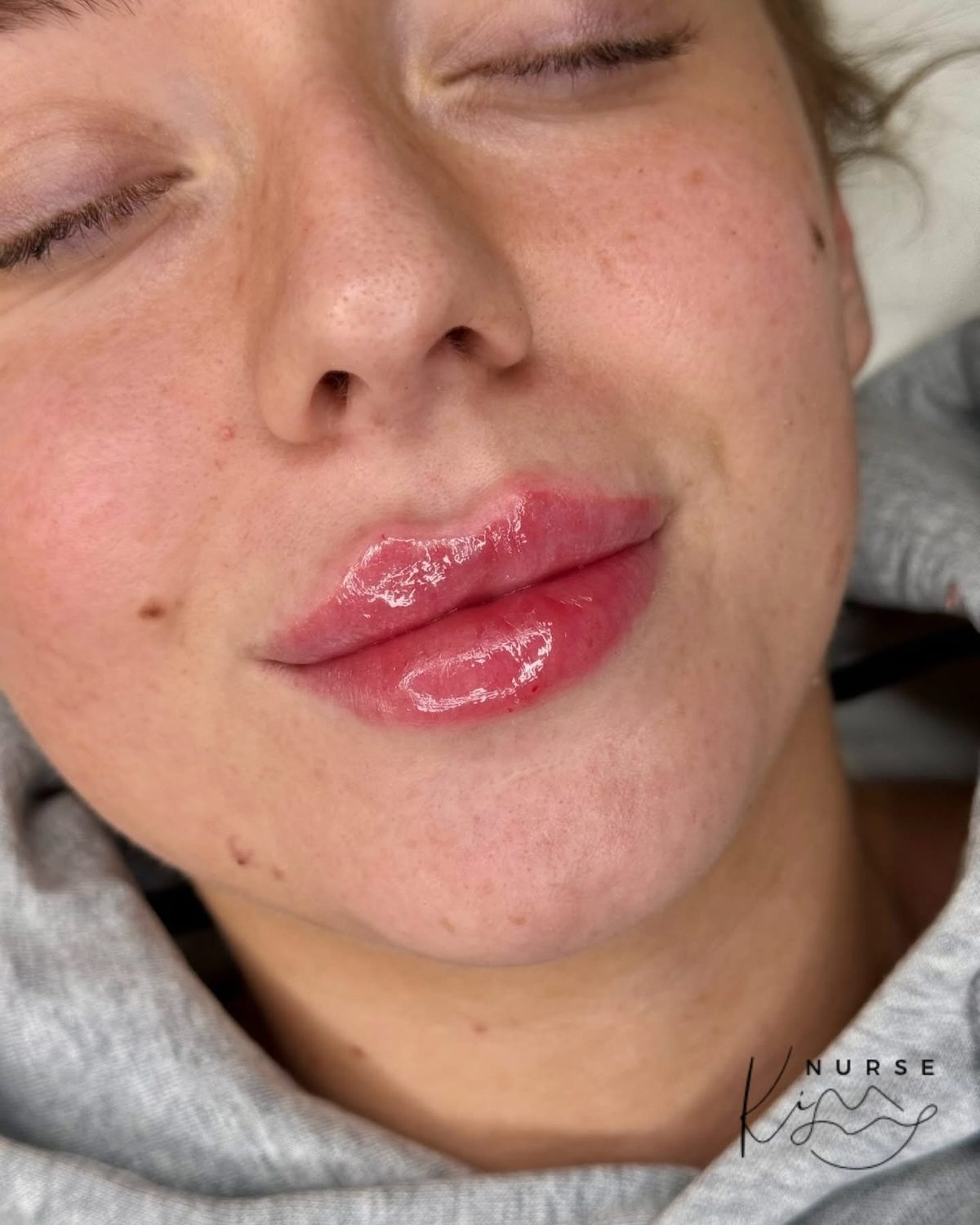 Lip Filler result