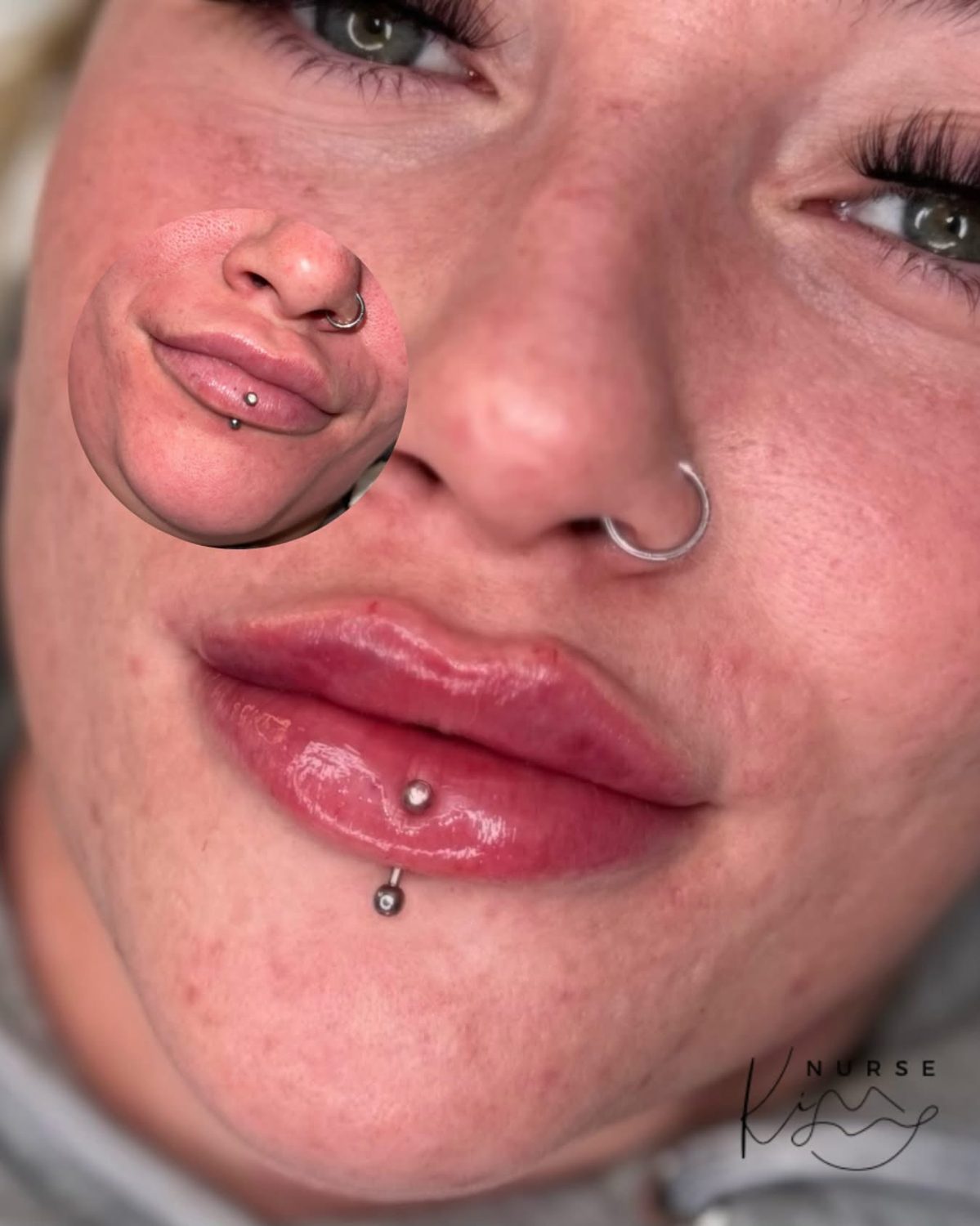 Lip Filler result