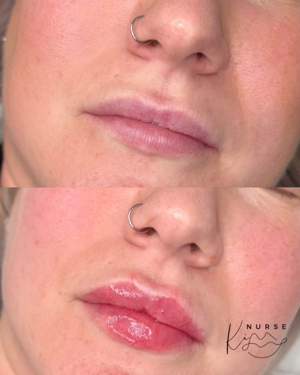 Lip Filler result